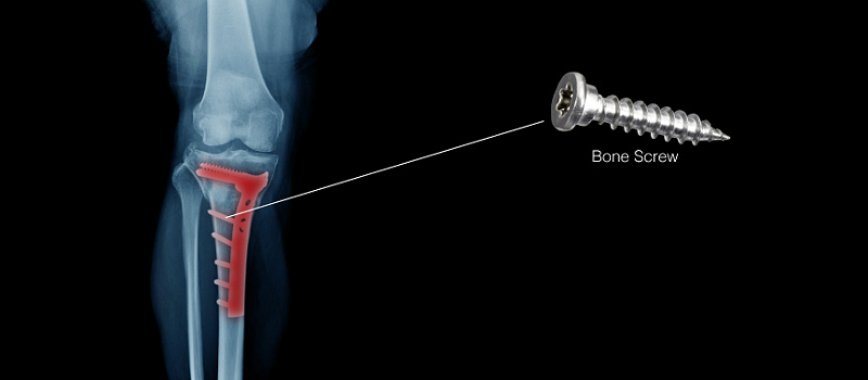 骨釘醫(yī)療梅花銑削.png 骨釘醫(yī)療梅花銑削.png